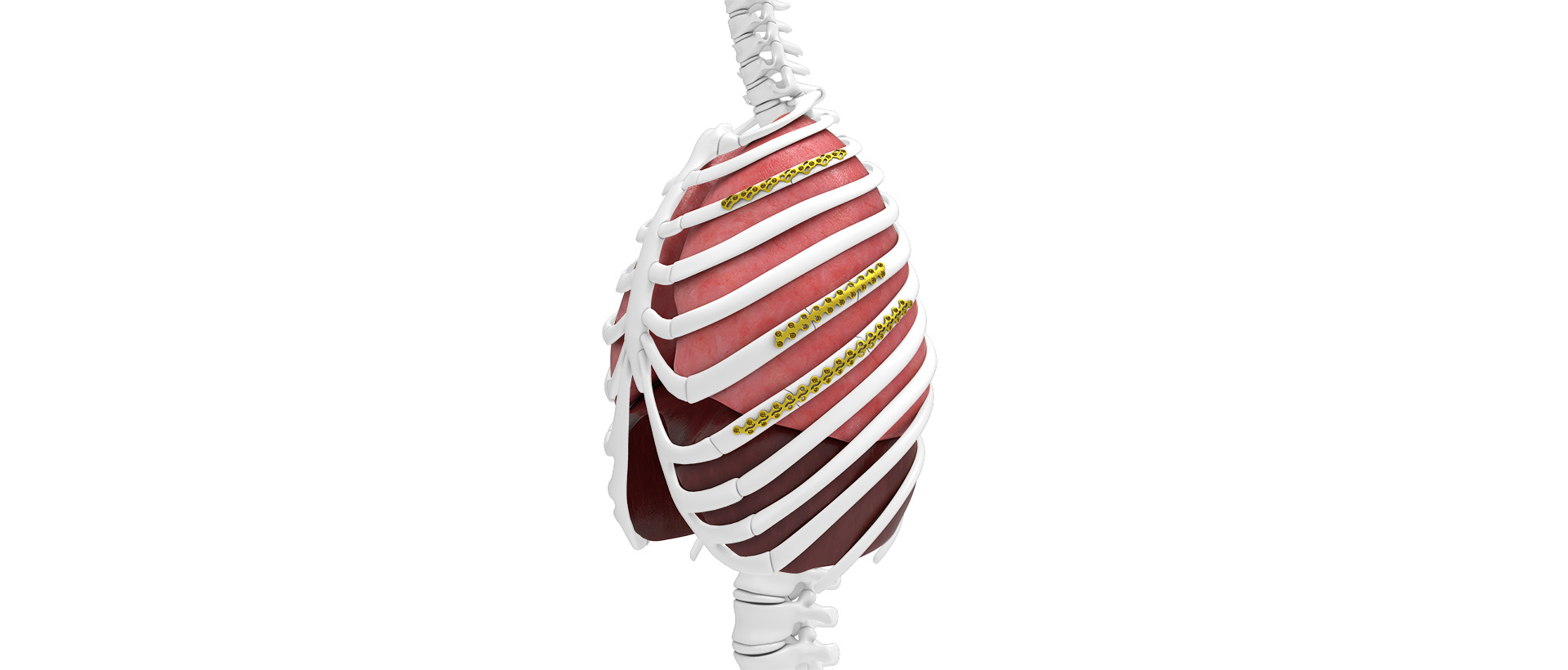 Thoracic implants